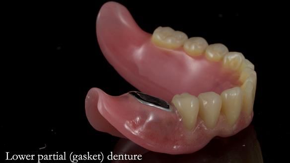 Newsletter 82 Mary - A complete upper and a one-tooth gasket denture