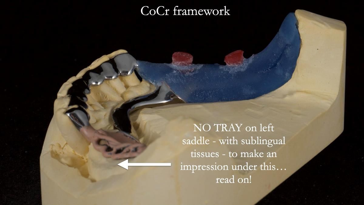 Newsletter 87 – Father Peter: A Partial Denture that needed Minor Miracle