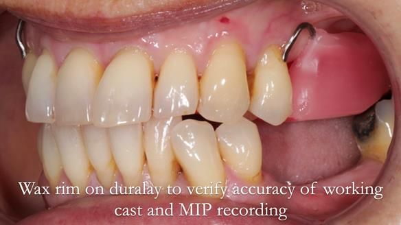 Newsletter 56 showing the making and fitting of a bilateral free end saddle upper removable partial denture (RPD) for patient with pemphigus