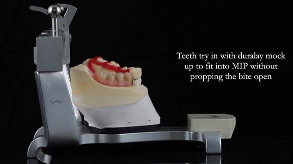 Finlay's Newsletter 61 provision of a lower unilateral free end saddle metal based partial denture for Joyce