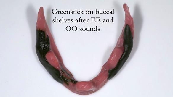 Replacing Madeline’s Complete denture FULL PROTOCOL