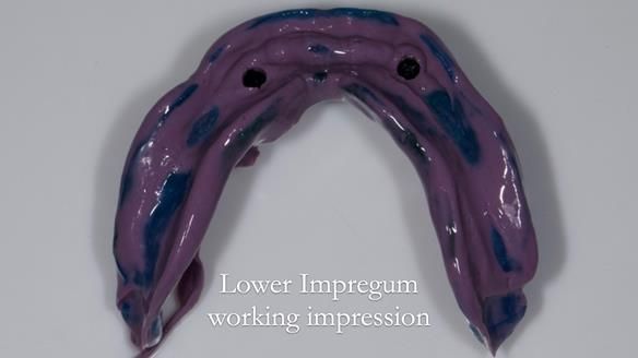 Newsletter 57 showcases the making and fitting process of implant-supported complete dentures for Alisdair