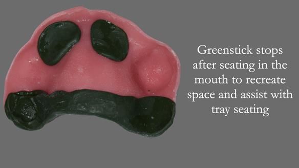 Newsletter 52 Managing Jo’s failing dentition with extractions and Mk 1/Mk 2 complete upper dentures and lower partial dentures FULL PROTOCOL