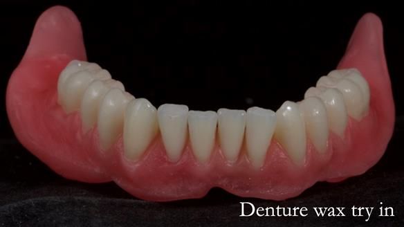 Newsletter 70 Complete Denture Treatment for Kate: A Case Study on Natural-Looking Dentures and Implant-Supported Overdentures
