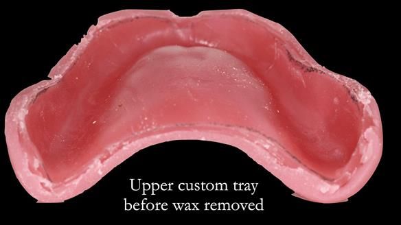 Complete denture Class II div 2 deep overbite Newsletter 39