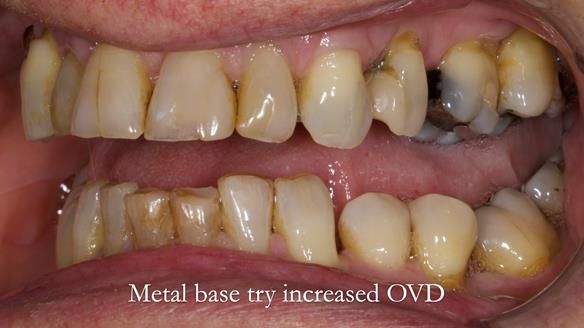 Finlay's Newsletter 64 case study - provision of a Kennedy class 2 metal based Scandinavian RPD for Ian