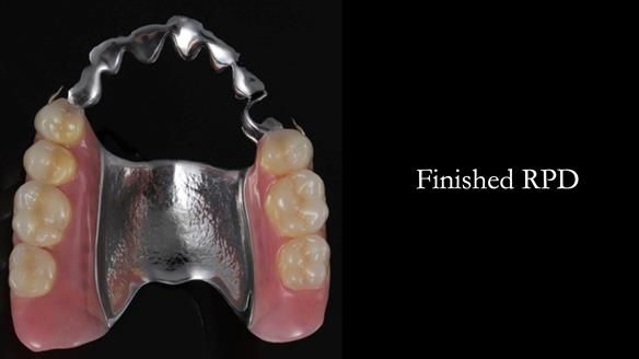 Newsletter 56 showing the making and fitting of a bilateral free end saddle upper removable partial denture (RPD) for patient with pemphigus
