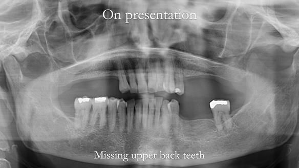 Newsletter 56 showing the making and fitting of a bilateral free end saddle upper removable partial denture (RPD) for patient with pemphigus