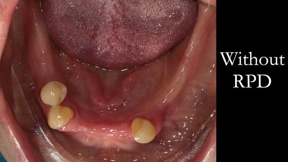 Finlay's Case Study Newsletter 40 - Immediate Mk 1 RPD to Definitive Mk 2 RPD - full protocol