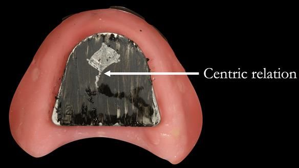 The tip of the triangle is the most reproducible jaw position for an edentulous patient - centric relation