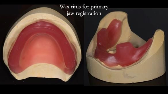 Newsletter 75: Marion’s case - Step-by-step complete denture workflow