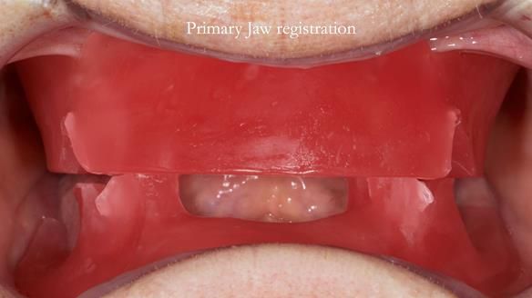 This is trimmed to the occlusal vertical dimension. When the patient looks right they are right.