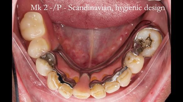 Newsletter 54 case presentation upper complete denture and lower Scandinavian designed hygienic partial denture for David