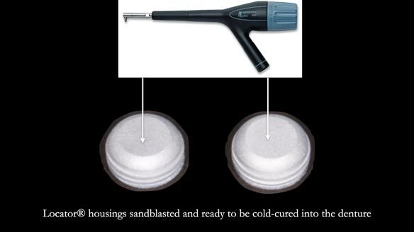 Newsletter 78: What do Clark Gable and a Locator® overdenture have in common?