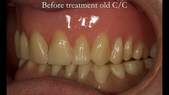 Complete denture Class II div 2 deep overbite Newsletter 39