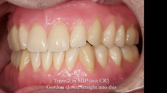 Newsletter 80 - Gordon’s dentures: the one case in 1,000 where my technique failed