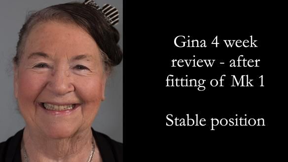 Finlay's Case Study Newsletter 40 - Immediate Mk 1 RPD to Definitive Mk 2 RPD - full protocol