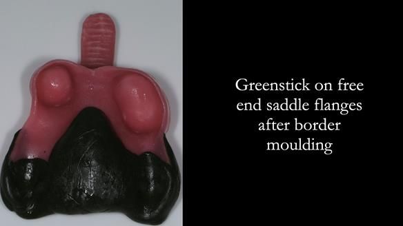 Finlay's Newsletter 59 Ultra hard partial dentures made for Gill