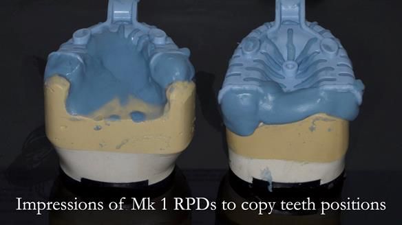 Finlay's Case Study Newsletter 40 - Immediate Mk 1 RPD to Definitive Mk 2 RPD - full protocol