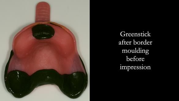 Newsletter 76: Jackie’s case – Telescopic overdenture & precision RPD (the tricky truth!)