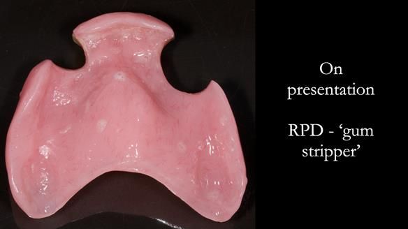 Finlay's Newsletter 59 Ultra hard partial dentures made for Gill