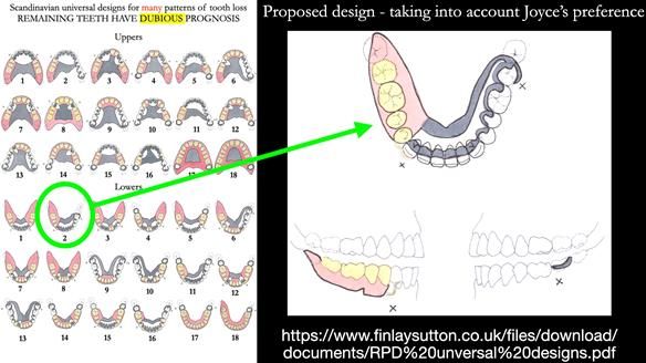 Finlay's Newsletter 61 provision of a lower unilateral free end saddle metal based partial denture for Joyce