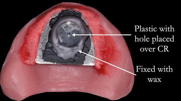 Newsletter 52 Managing Jo’s failing dentition with extractions and Mk 1/Mk 2 complete upper dentures and lower partial dentures FULL PROTOCOL