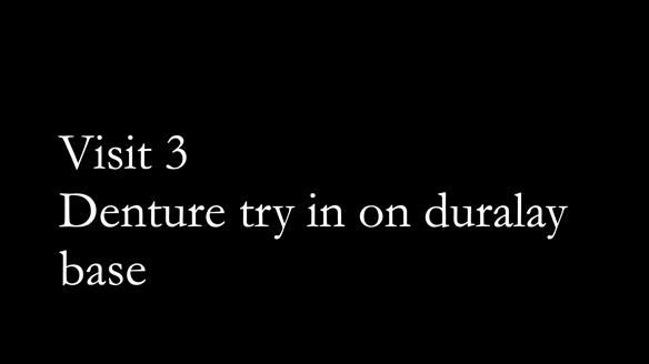 Finlay's Newsletter 64 case study - provision of a Kennedy class 2 metal based Scandinavian RPD for Ian