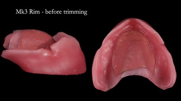 Newsletter 77: Jeremy’s case – immediate complete upper denture