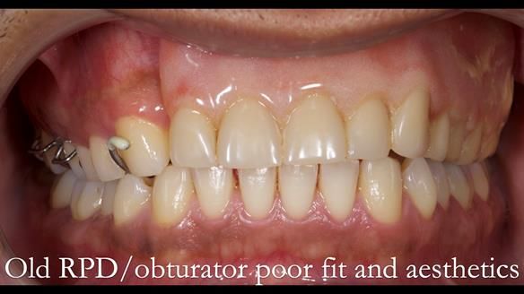 Acrylic based partial denture/obturator had poor, retention and support Obturator section was in poor condition. The Adams clasp were causing inflammation of the gingival margins. The clasp on the UR3 was visible resulting in poor appearance. Reduced lip 