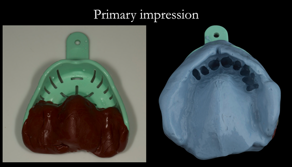 Figure 14 Upper primary impression - 2 stages compound first to record the free end saddles and alginate medium wash