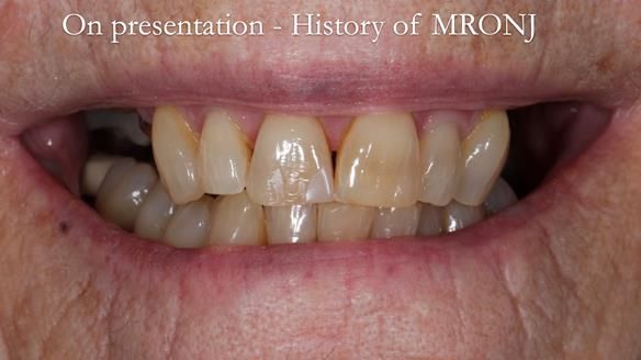 Finlay's Newsletter 60 Sylvia's upper Kennedy Class 2 Mod 1 metal based upper RPD