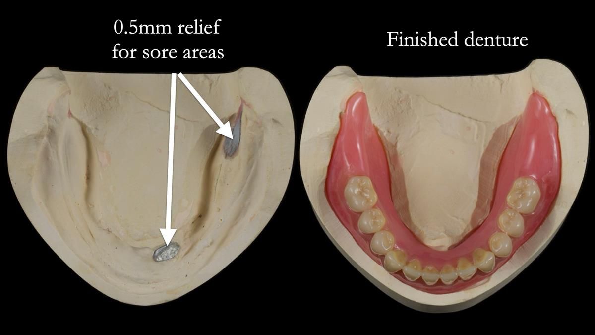 Fin’s Newsletter 88 — Complete dentures - full protocol… he rearranged his own teeth!