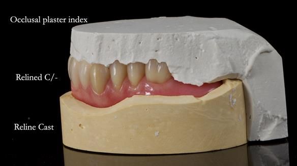 Newsletter 77: Jeremy’s case – immediate complete upper denture