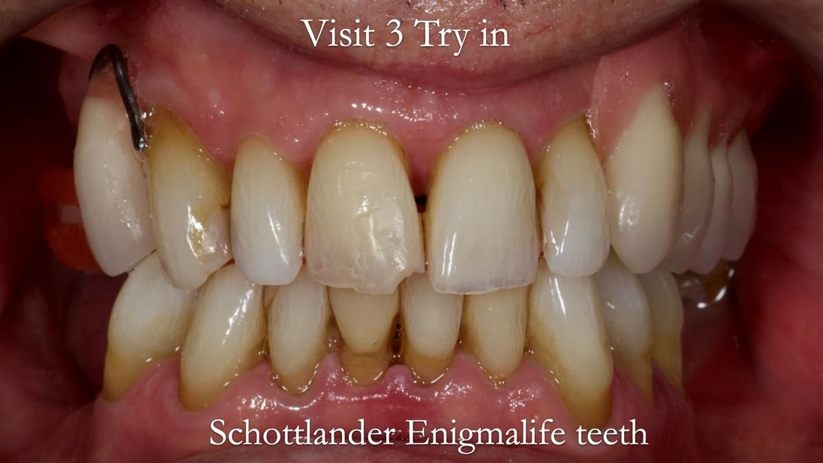 Newsletter 89 – Simon: A Challenging Kennedy Class II Division 1 Upper CoCr Partial Denture with a High Smile Line