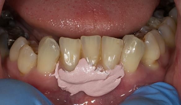 Figure 47 1 month after extractions - Immediate denture laboratory reline - part 1 with Zinc Oxide impression material