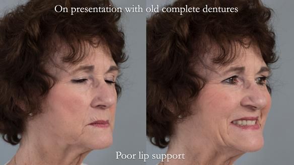Newsletter 75: Marion’s case - Step-by-step complete denture workflow
