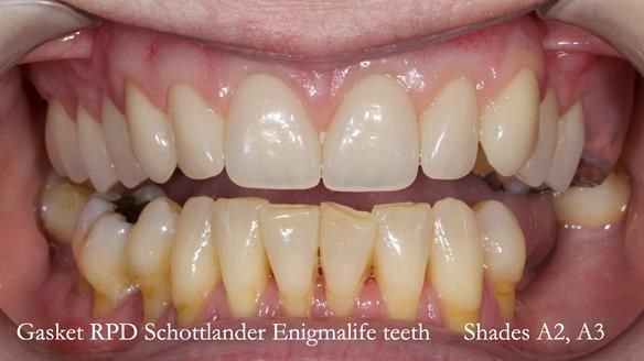 Finlay's Newsletter 58 Gasket upper partial denture for Zoe