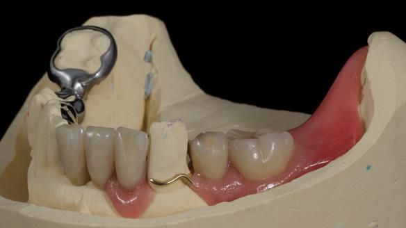 Newsletter 86 Peter the Architect — precision removable partial dentures case study