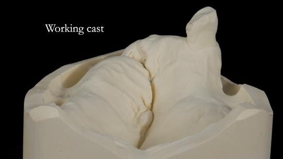 Newsletter 55 Provision of metal based partial dentures for Zephyrine with a repaired cleft lip and palate