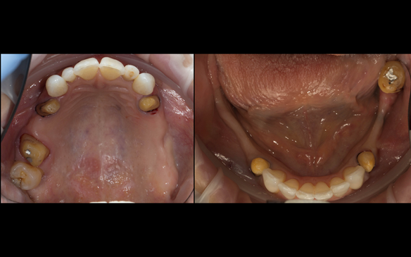Figure 44 Porcelain fused to zirconia crown preparations (previously bridge abutment crowns).