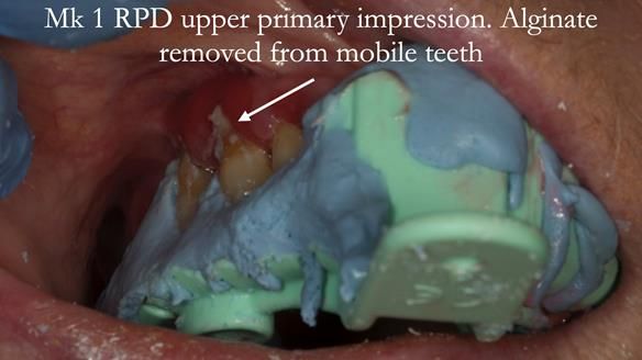 Finlay's Case Study Newsletter 40 - Immediate Mk 1 RPD to Definitive Mk 2 RPD - full protocol
