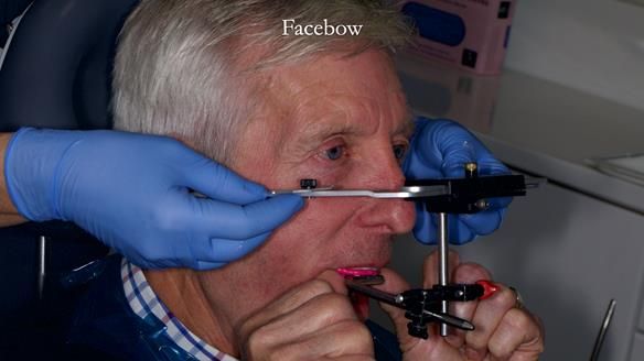 Newsletter 77: Jeremy’s case – immediate complete upper denture