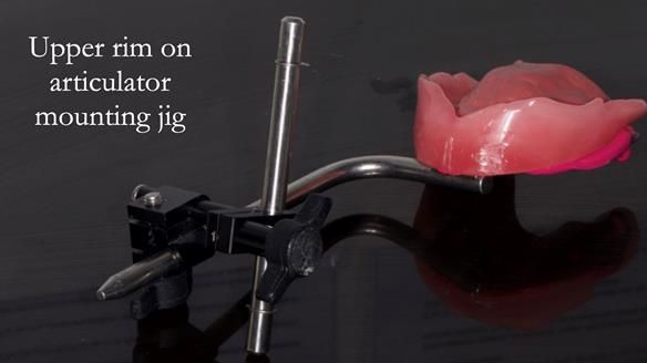 Newsletter 57 showcases the making and fitting process of implant-supported complete dentures for Alisdair