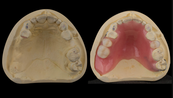 Figure 22 Finished upper immediate denture. Schottlander Enigmalife teeth.