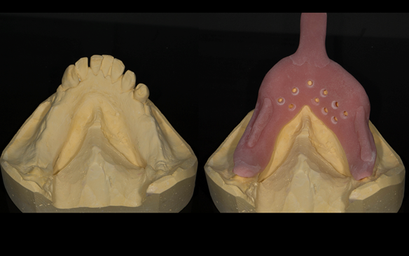Figure 70 Mandibular primary cast and special tray for Mk 2 denture