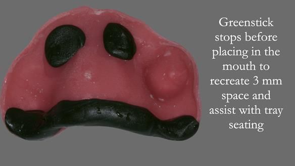 Newsletter 52 Managing Jo’s failing dentition with extractions and Mk 1/Mk 2 complete upper dentures and lower partial dentures FULL PROTOCOL