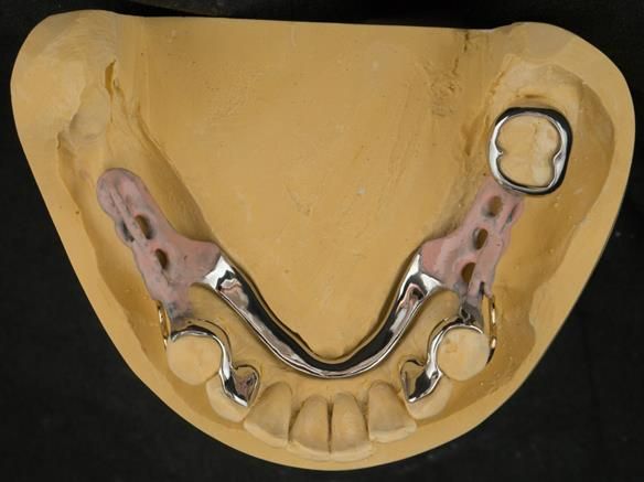 Figure 69 cobalt chromium framework - Scandinavian design with sublingual bar - keeping the denture components 3mm away from the gingival margin.