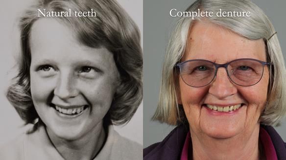 Newsletter 82 Mary - A complete upper and a one-tooth gasket denture