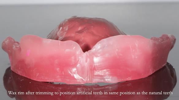 Finlay's Newsletter 62 provision of extractions and metal based complete dentures for Rafique